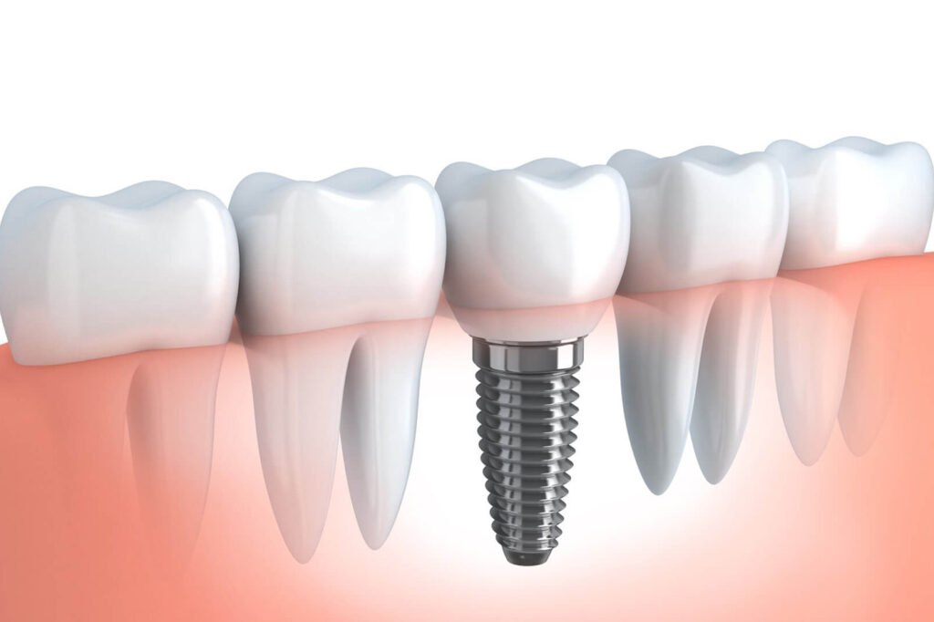 Desktop elektronenmicroscopie als kwaliteitssysteem voor tandheelkundige implantaten